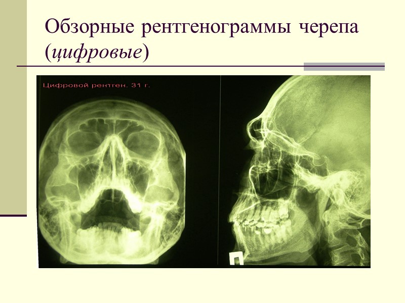 Обзорные рентгенограммы черепа (цифровые)